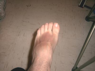 Foot bruise