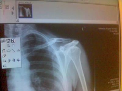 X-ray